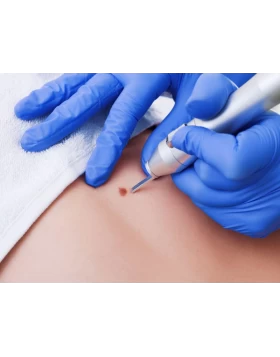 Mole removal with CO2 Laser