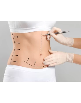 Abdominoplasty