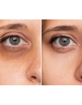 Correcting Dark Circles