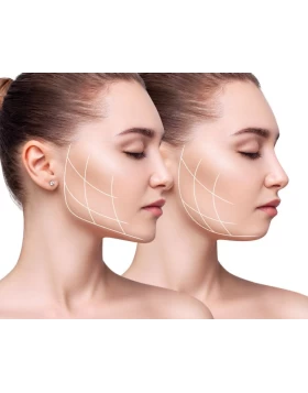 Facial contouring