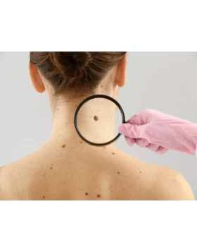 Moles - Skin Cancers