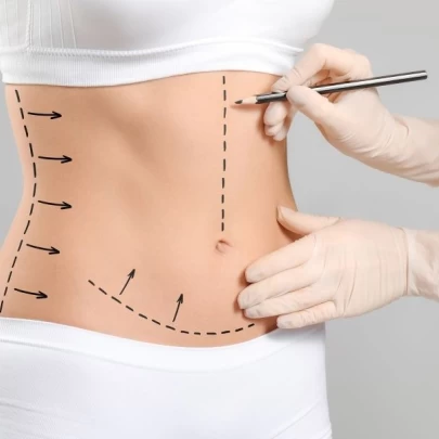 Abdominoplasty